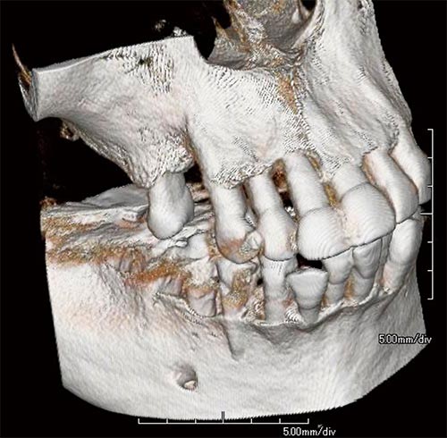 インプラント治療で歯科用CTを併用することで治療精度がさらに高まります