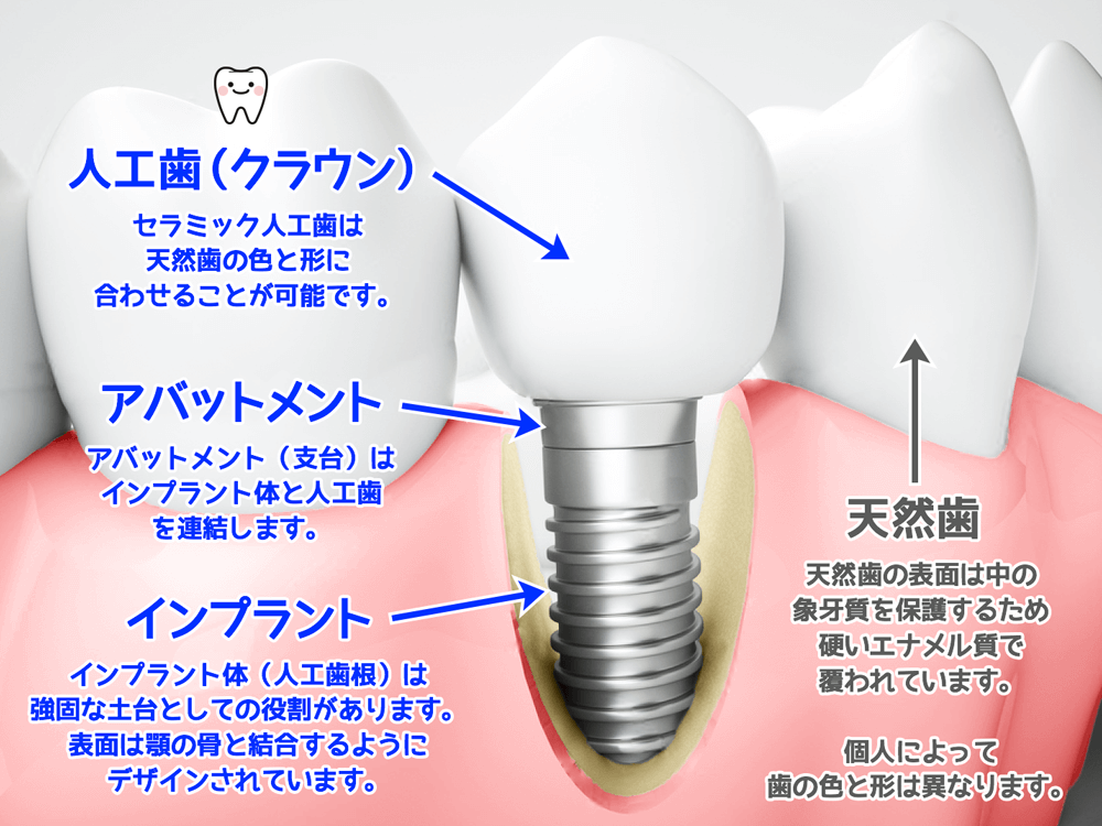 天然歯とインプラントの違い