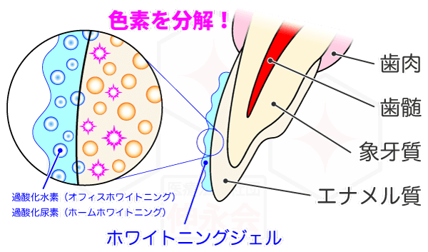 過酸化水素と過酸化尿素が色素を分解して歯を白くします